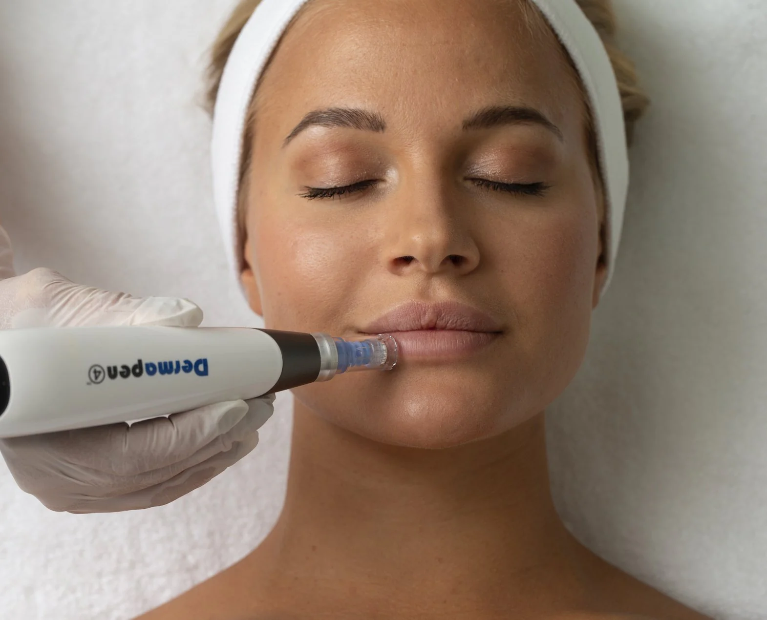Microneedling